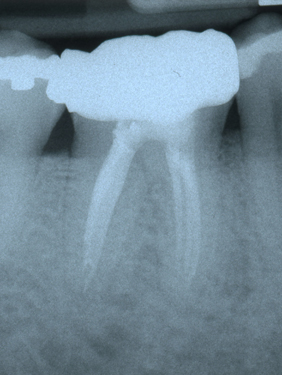 middle mesial canal